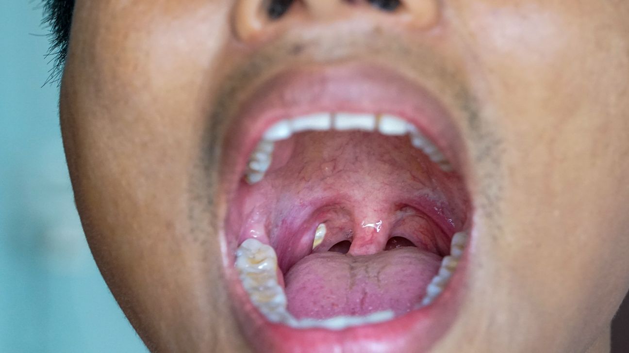 Effective Ways to Get Rid of Tonsil Stones at Home in 2025: Discover Proven Techniques and Methods