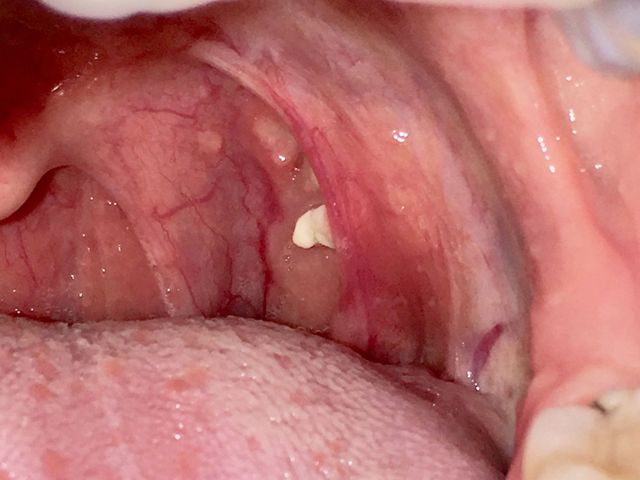 Tonsil Stones Removal