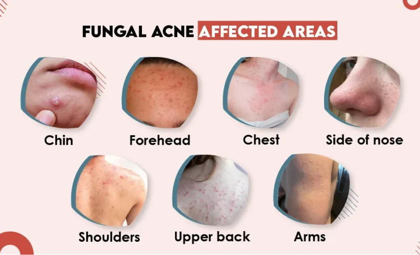 Effective Ways to Get Rid of Fungal Acne: Discover Proven Treatments in 2025