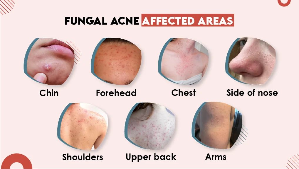 Effective Ways to Get Rid of Fungal Acne: Discover Proven Treatments in 2025